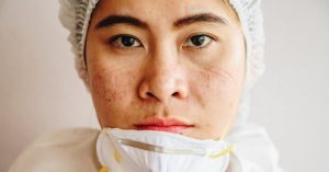 Cara Mengatasi Jerawat Karena Memakai Masker