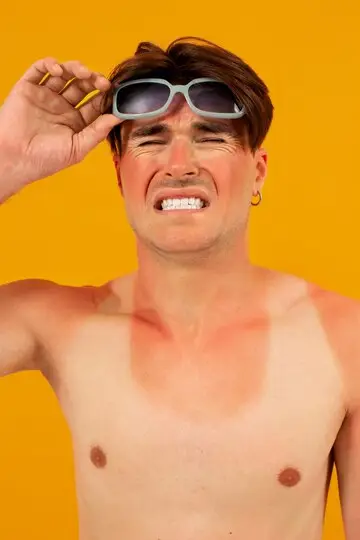 Sunburn Usai Liburan? Ini Perawatan Kulit Terbaik untuk Mengurangi Kemerahan