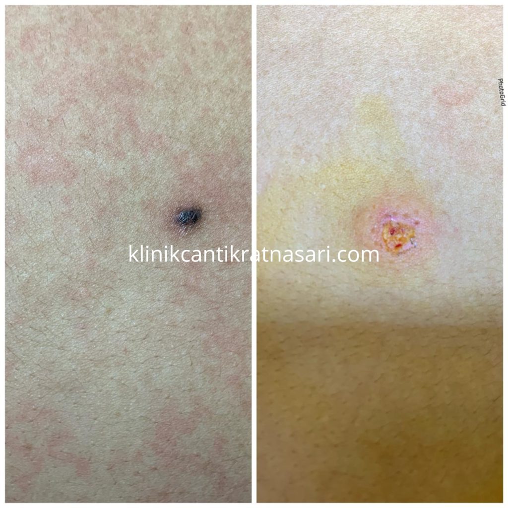 hilangkan tahi lalat aman