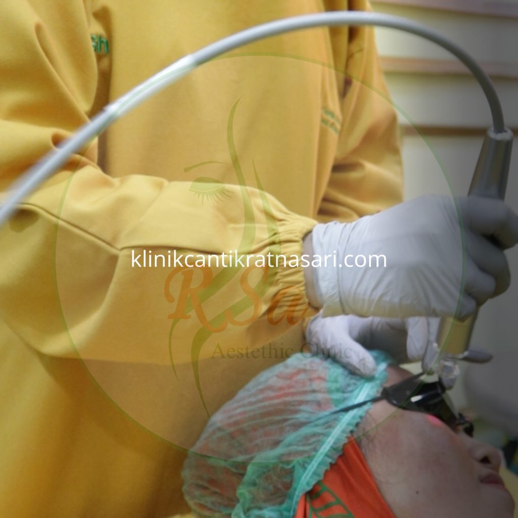 laser acne glowing promo bandung
