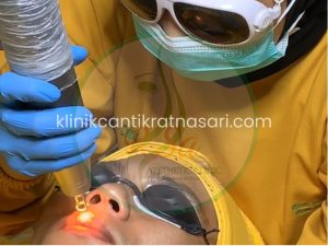 harga laser bibir gelap