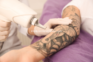 Hapus tato bandung