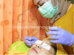 Jerawat yang muncul berulang di tempat yang sama pada area wajah