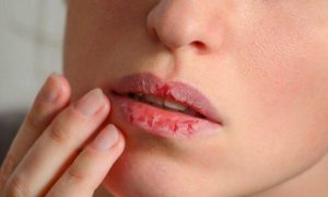 SOLUSI BIBIR KERING