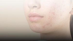 Klinik Kecantikan Bandung untuk flek jerawat dan bopeng di RSA Aesthetic Clinic