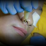 Treatment Microcauter untuk menghilangkan tahi lalat di Bandung