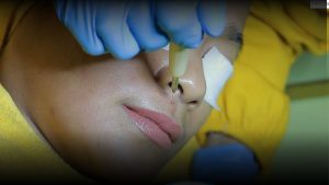 Treatment Microcauter untuk menghilangkan tahi lalat di Bandung