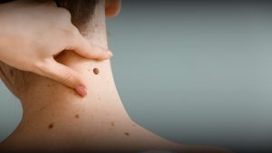 Klinik penghilang tahi lalat Bandung dan Soreang di RSA Aesthetic Clinic