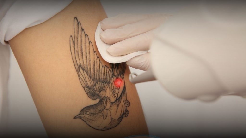 Treatment Laser Nd untuk hapus tato di RSA Aesthetic Clinic Bandung
