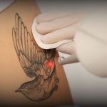 Treatment Laser Nd untuk hapus tato di RSA Aesthetic Clinic Bandung