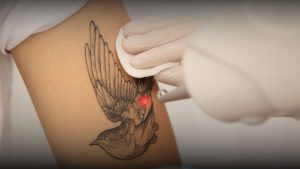 Treatment Laser Nd untuk hapus tato di RSA Aesthetic Clinic Bandung