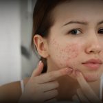 Laser CO2 Fractional untuk membantu memperbaiki tampilan bopeng bekas jerawat di Bandung