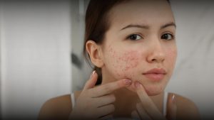 Laser CO2 Fractional untuk membantu memperbaiki tampilan bopeng bekas jerawat di Bandung