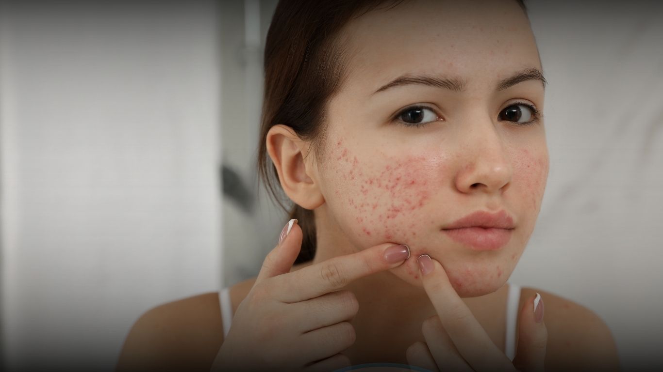 Laser CO2 Fractional untuk membantu memperbaiki tampilan bopeng bekas jerawat di Bandung