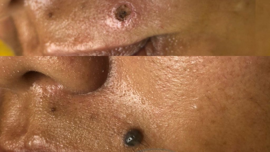 Konsultasi menghilangkan tahi lalat di Bandung di RSA Aesthetic Clinic