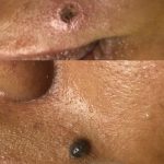 Konsultasi menghilangkan tahi lalat di Bandung di RSA Aesthetic Clinic