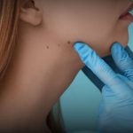 Biaya menghilangkan tahi lalat di Bandung 2026 dengan Microcauter di RSA Aesthetic Clinic
