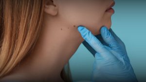 Biaya menghilangkan tahi lalat di Bandung 2026 dengan Microcauter di RSA Aesthetic Clinic