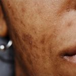 Konsultasi treatment flek hitam di RSA Aesthetic Clinic Kabupaten Bandung
