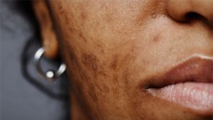 Konsultasi treatment flek hitam di RSA Aesthetic Clinic Kabupaten Bandung